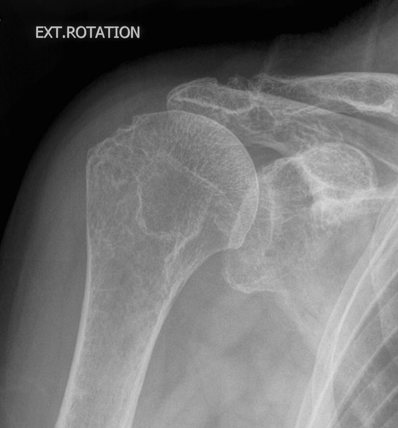 Rotator Cuff Arthropathy